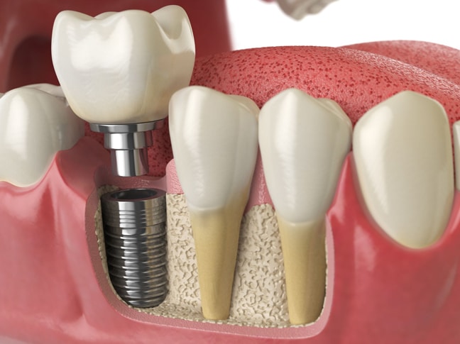 Why Might A Bone Grafting Be Needed
