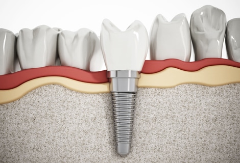 Why Would Dental Implants Be Needed