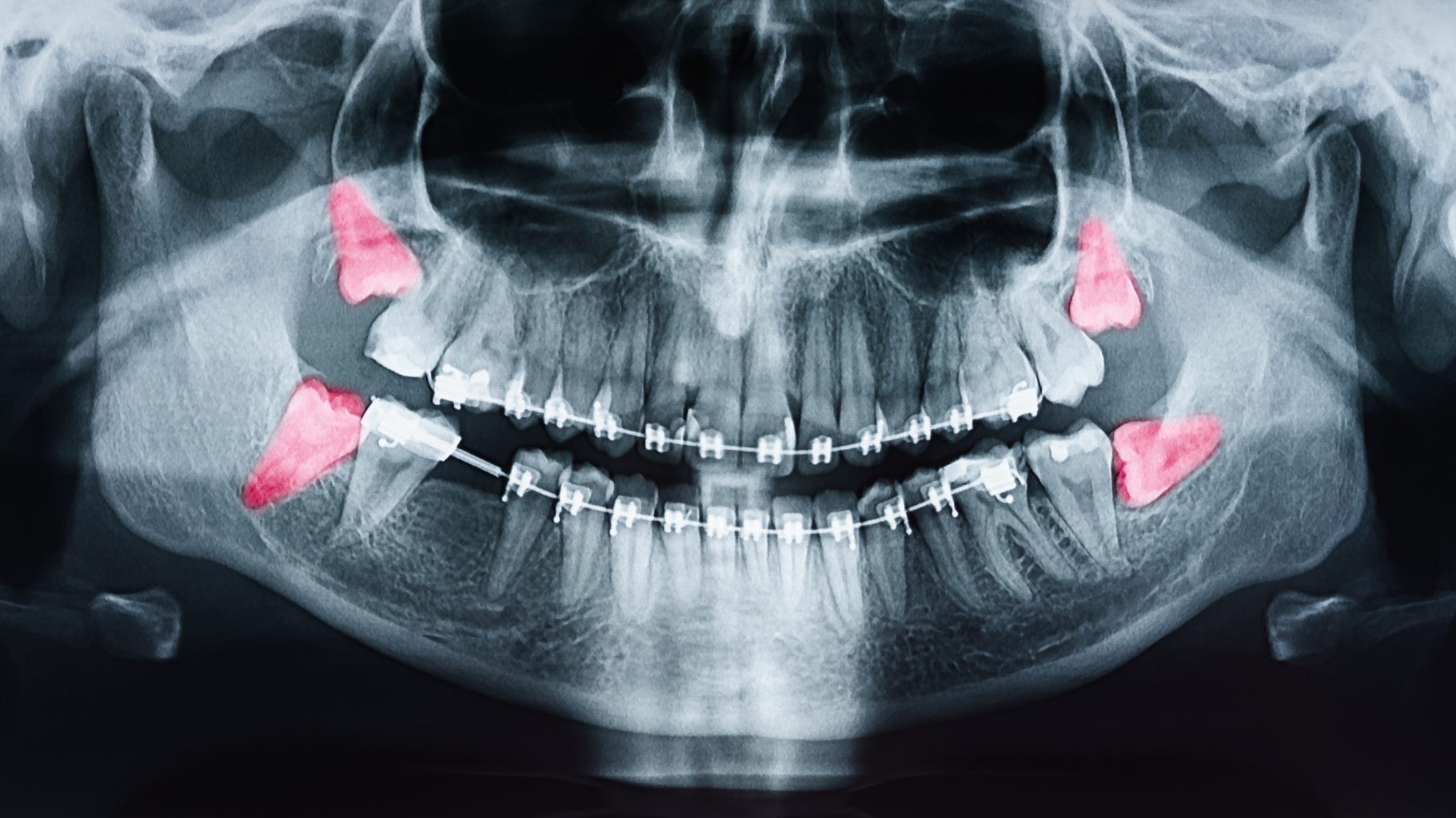 Growing Wisdom Teeth Pain On X Ray