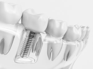 how painful is the dental implant process
