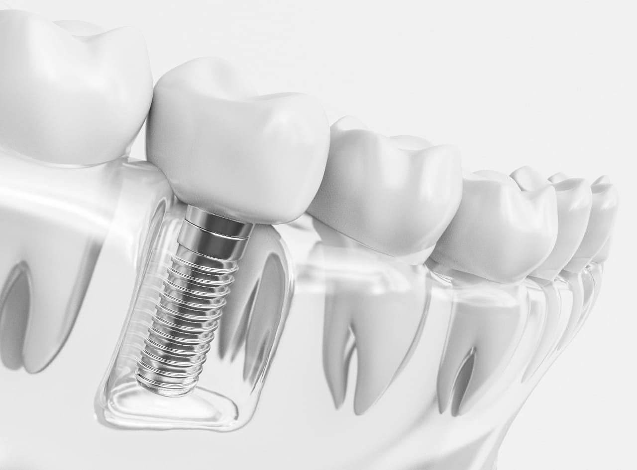 how painful is the dental implant process