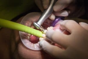 operation facet gloves teeth grind dentist health