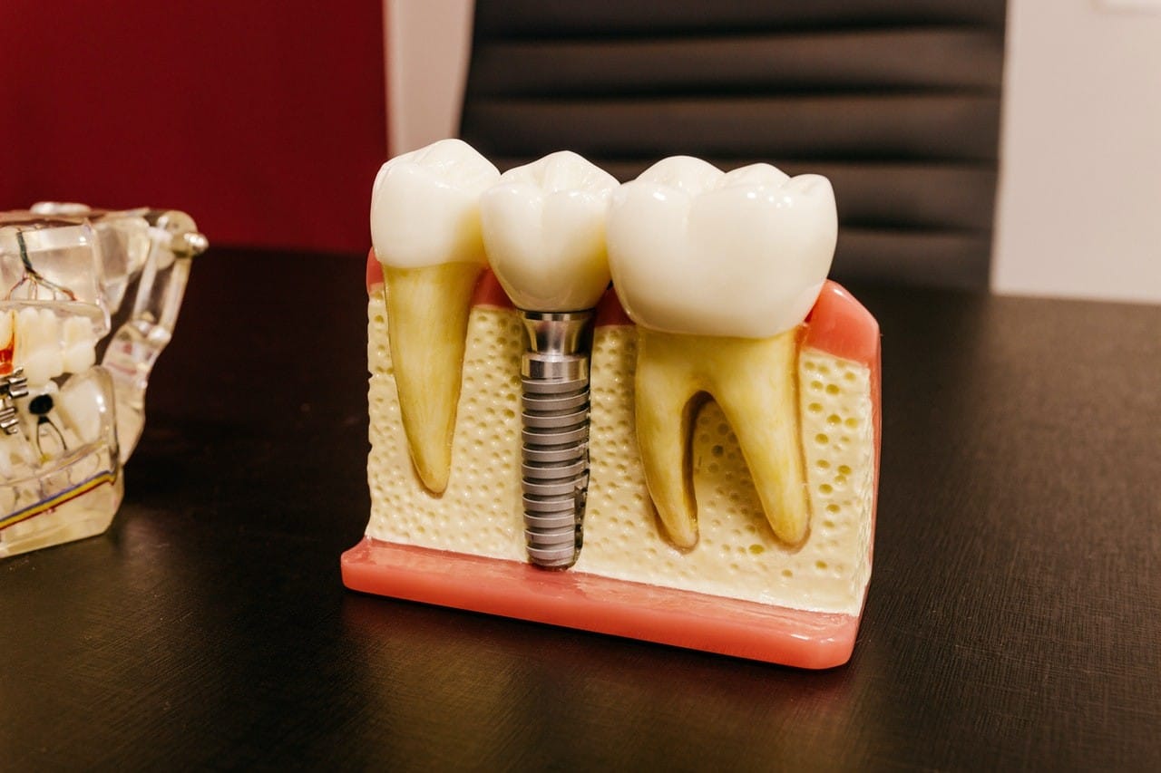 all on 4 teeth implants