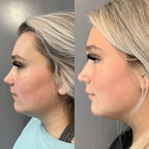 female patient before and after corrective jaw surgery