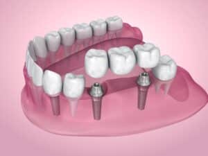An example of an implant supported bridge in Wylie, TX