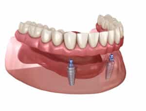 An example of arch on 4 dental implants