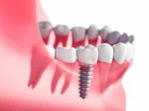 An illustration of a single dental implant