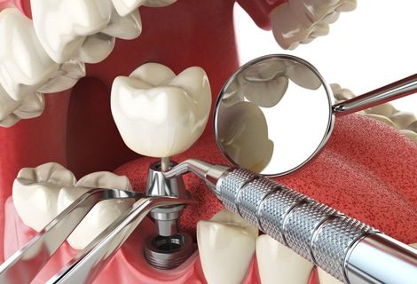 Dental Implants Are Designed To Replace